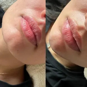 0.5ML CHIN FILLER