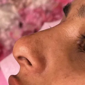 NON SURGICAL RHINOPLASTY